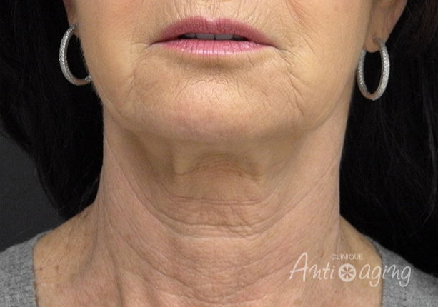 Sculptra Treatment: A Revolutionary Approach to Facial Rejuvenation Sculptra Treatment: A Revolutionary Approach to Facial Rejuvenation