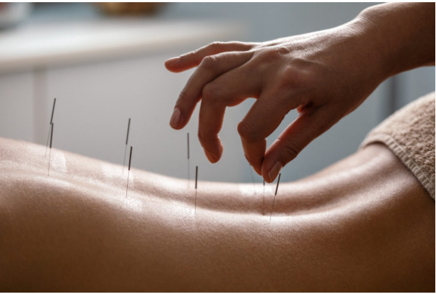 How Acupuncture Can Relieve Stress and Improve Your Wellbeing How Acupuncture Can Relieve Stress and Improve Your Wellbeing
